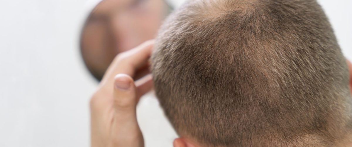 adult-male-having-balding-problems