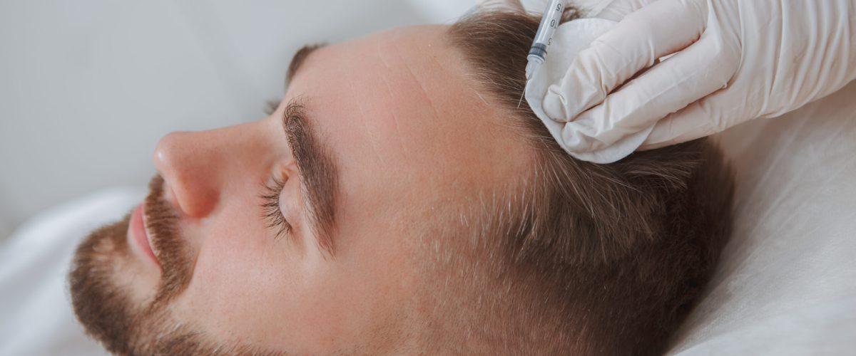 Transplante Capilar: Como Funciona e Quais os Resultados Esperados