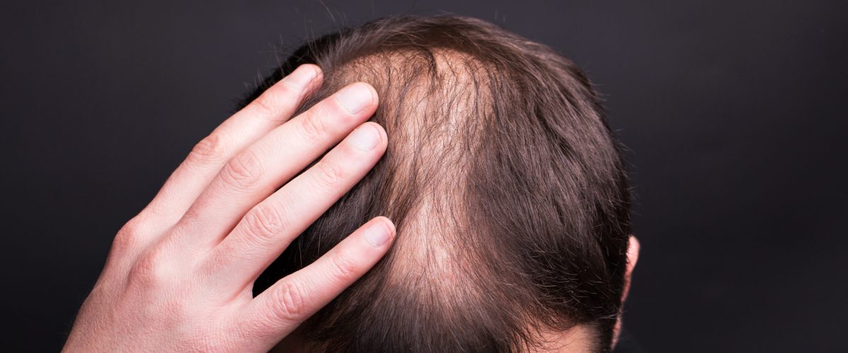 Male head close-up with baldness. Studio black background.